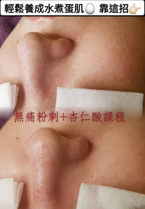 聖誕節優惠方案~臉部保養❤️優惠方案~杏仁酸3堂 ~ 特價2970元