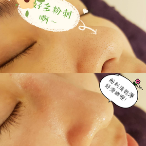 聖誕節優惠方案~臉部保養❤️粉刺淨痘 8 堂